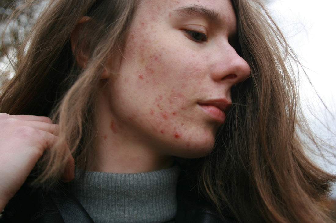 How cannabis helps treat acne – Benefits and best practices at 24Supplements.